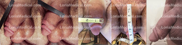 Penile Enlargement Portrait Gallery: BRAJAR Loria Medical Male Enhancement Image