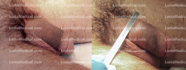 Penile Enlargement Portrait Gallery: CANADA Loria Medical Male Enhancement Image