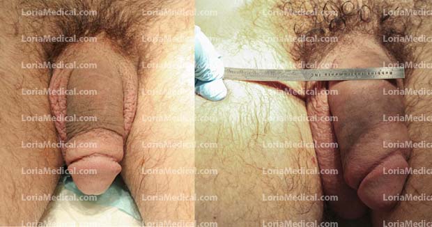 Penile Enlargement Portrait Gallery: CANADA Loria Medical Male Enhancement Image