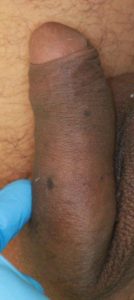 Circumcision and Circumcision Corrective Surgery