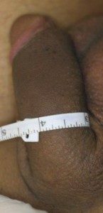 Circumcision