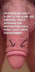 Circumcision Correction