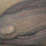 Circumcision Surgery before and after