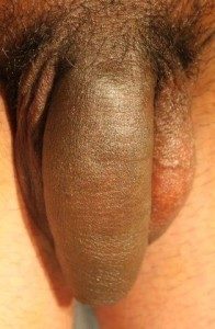 Pictures Circumcision Corrective Surgery