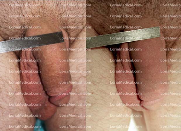 Penile Enlargement Portrait Gallery: ACORN Loria Medical Male Enhancement Image