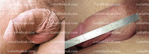 Penile Enlargement Portrait Gallery: GARY Loria Medical Male Enhancement Image