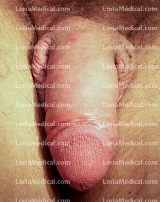 Penile Enlargement Portrait Gallery: GARY Loria Medical Male Enhancement Image