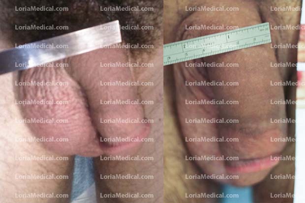 Penile Enlargement Portrait Gallery: GOY Loria Medical Male Enhancement Image