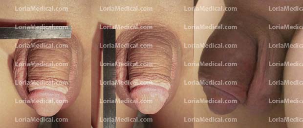Penile Enlargement Portrait Gallery: LJ Loria Medical Male Enhancement Image