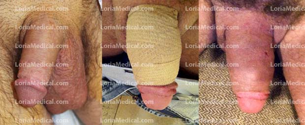 Penile Enlargement Portrait Gallery: MERKEN Loria Medical Male Enhancement Image