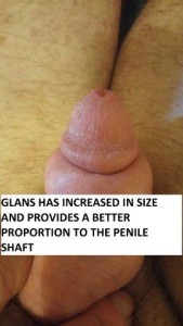 Penile Glans Before & After
