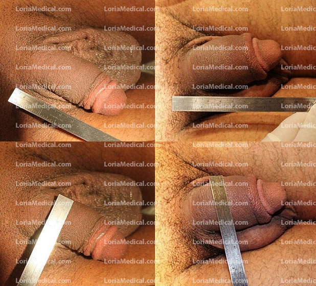 Penile Enlargement Portrait Gallery: Patient 7 Loria Medical Male Enhancement Image
