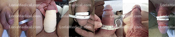 Penile Enlargement Portrait Gallery: TOBY Loria Medical Male Enhancement Image