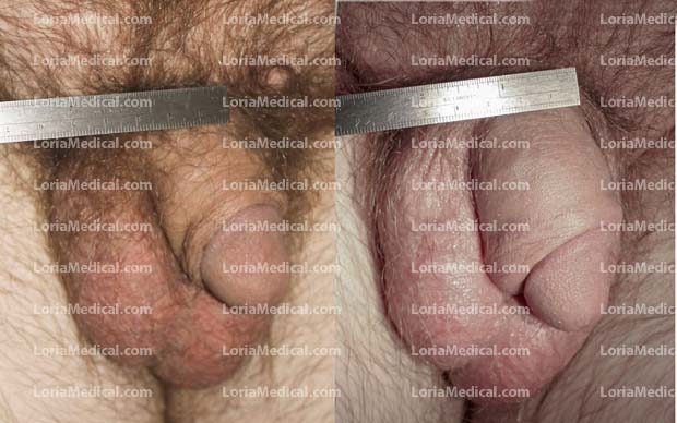 Penile Enlargement Portrait Gallery: TOM Loria Medical Male Enhancement Image