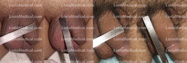 Penile Enlargement Portrait Gallery: TREE Loria Medical Male Enhancement Image