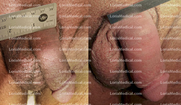 Penile Enlargement Portrait Gallery: WOOL Loria Medical Male Enhancement Image