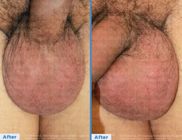 Scrotal Enhancement Loria Medical Male Enhancement Image