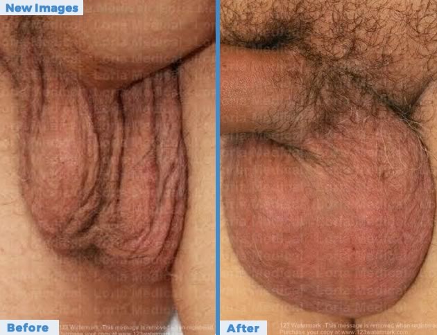 Scrotal Enhancement Loria Medical Male Enhancement Image