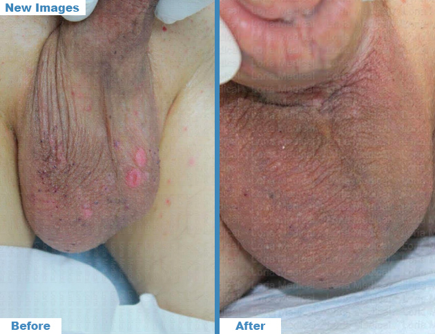 Scrotal Enhancement 4 Loria Medical Male Enhancement Image