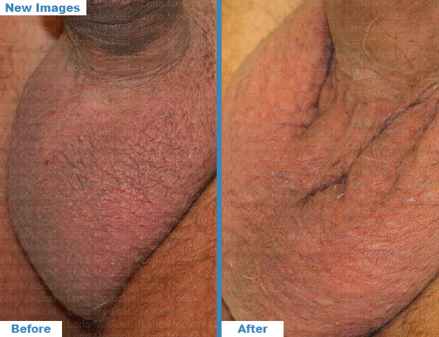 Scrotal Enhancement 5 Loria Medical Male Enhancement Image