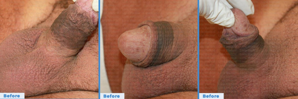 Scrotal Enhancement 5 Loria Medical Male Enhancement Image