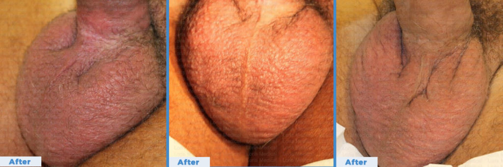 Scrotal Enhancement 5 Loria Medical Male Enhancement Image