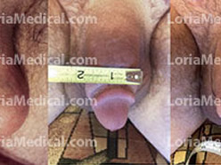 PENILE METAL ROD IMPLANT
