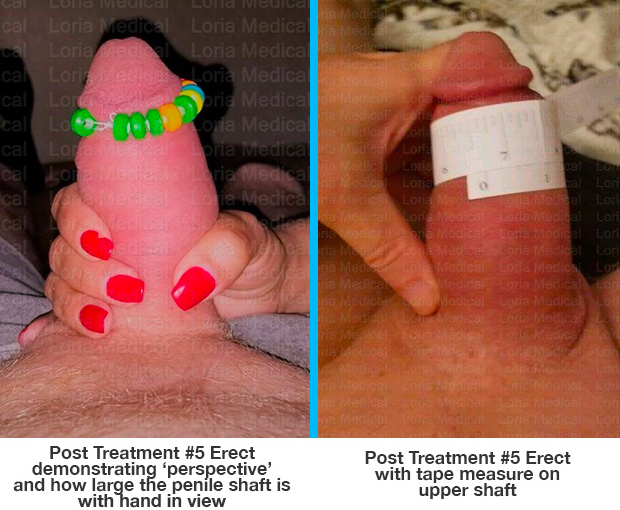 Post Treatment #5 Erect demonstrating 'perspective' and how large the penile shaft is with hand in view', Post Treatment #5 Erect with tape measure on upper shaft', and, 'Post Treatment #5 Erect with tape measure on mid-base shaft area