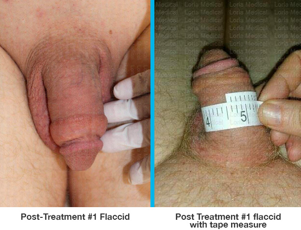 Post Treatment #1 flaccid