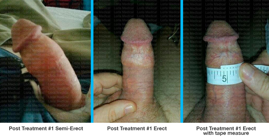 Post Treatment #1 Erect