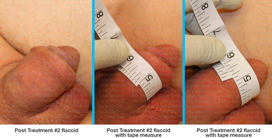 Post Treatment #2 flaccid, Post Treatment #2 flaccid with tape measure