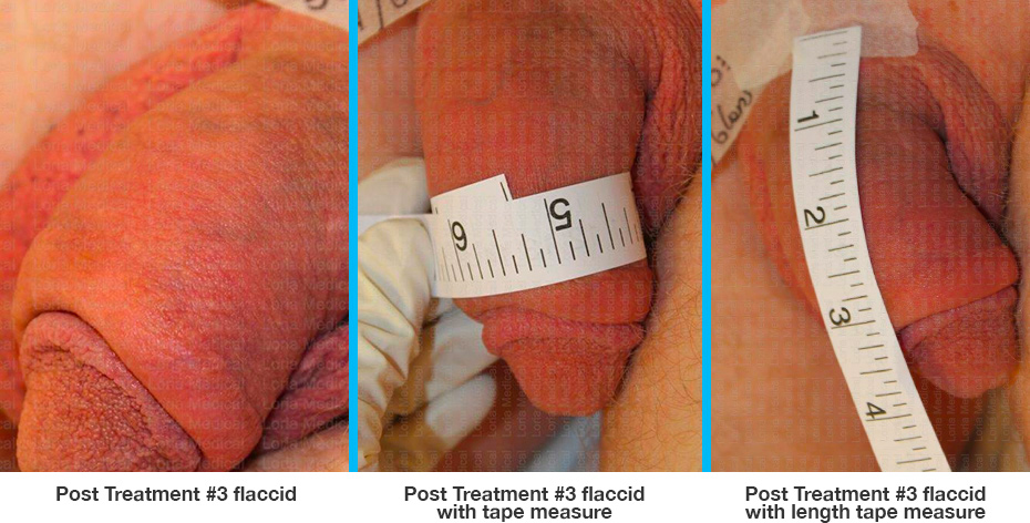 ‘Post Treatment #3 flaccid, Post Treatment #3 flaccid with tape measure, Post Treatment #3 flaccid with length tape measure.