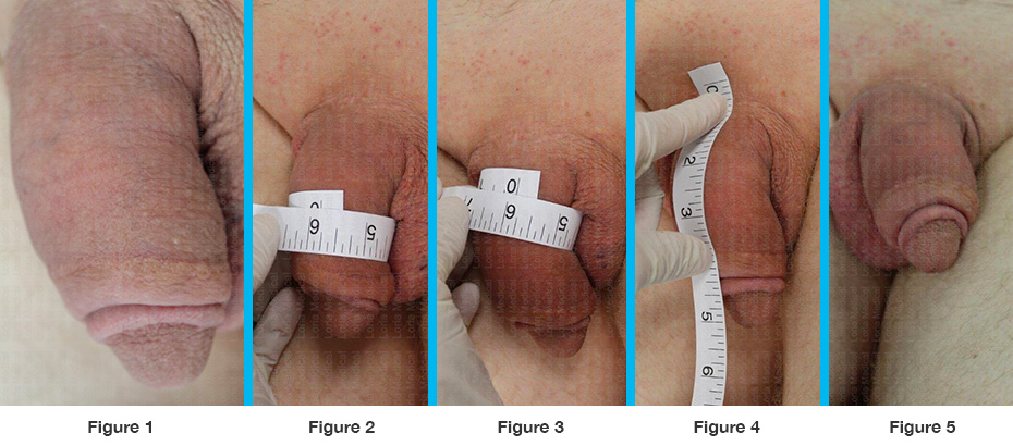 ‘Post Treatment #4 flaccid, Post Treatment #4 flaccid with tape measure mid shaft, Post Treatment #4 flaccid with tape measure at penile base,