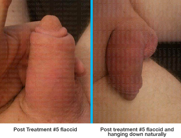‘‘Post Treatment #5 flaccid, Post treatment #5 flaccid and hanging down
naturally….respectively.