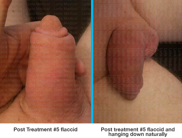 ‘‘Post Treatment #5 flaccid, Post treatment #5 flaccid and hanging downnaturally….respectively.