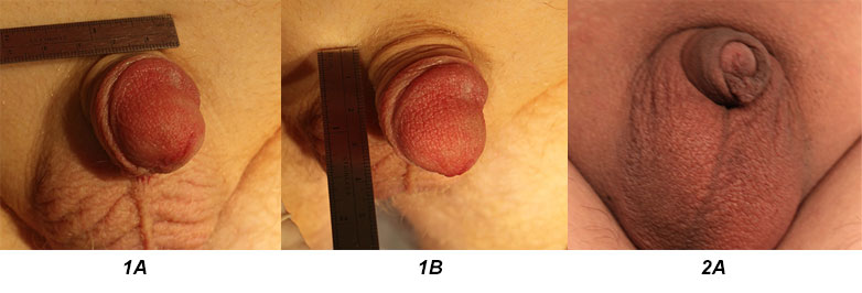 Micro penis enlargement proformed by Loria Medical in Miami Florida. 