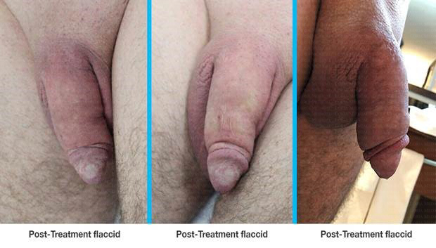 peyronies-desease-treatment-4