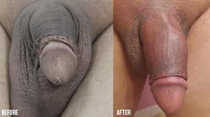 Penis-Enlargement-PENNSYLVANIA-1