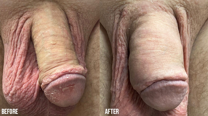 Penis-Enlargement-PENNSYLVANIA-2