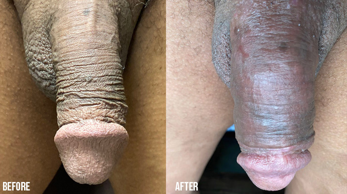 Penis-Enlargement-PENNSYLVANIA-3