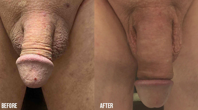Penis-Enlargement-PENNSYLVANIA-4