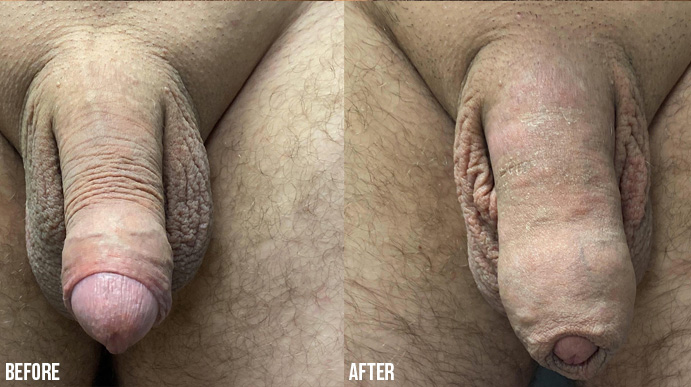 Penis-Enlargement-PENNSYLVANIA-5