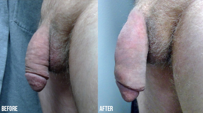 Penis-Enlargement-PENNSYLVANIA-6